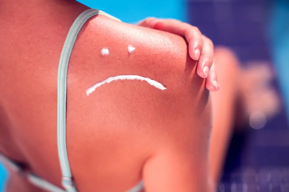 Sunburned shoulder with a sad face drawn in sunscreen near a swimming pool.